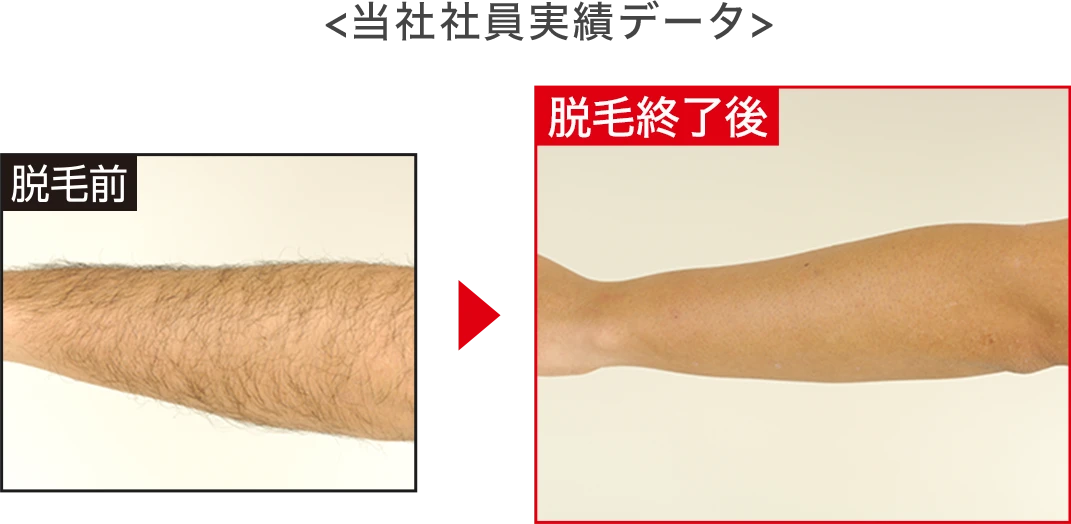 15年生えてきていない社員実績あり！