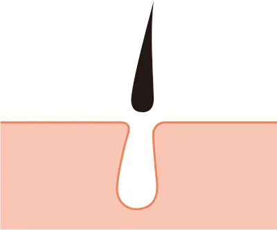 その場で毛がなくなる