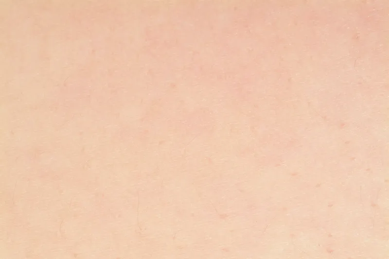 TBCスーパー脱毛終了後のキレイな肌