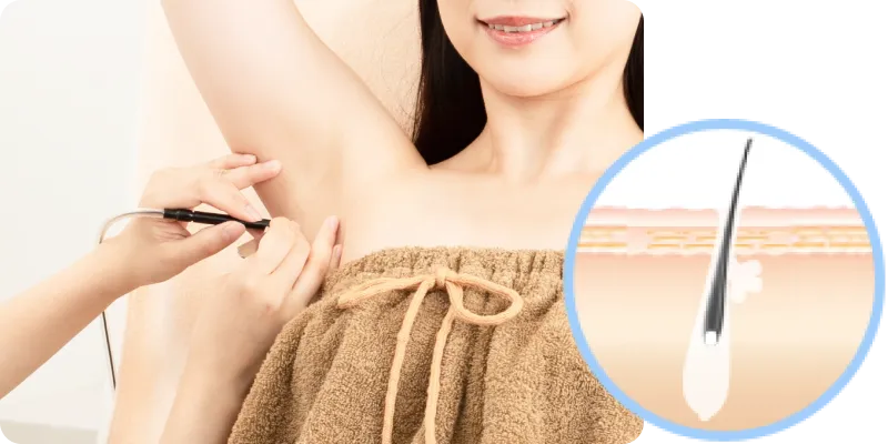 TBCスーパー脱毛