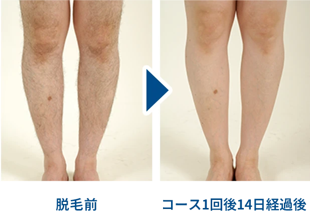 アシ脱毛効果