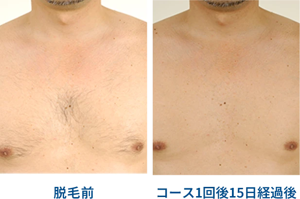 胸脱毛効果