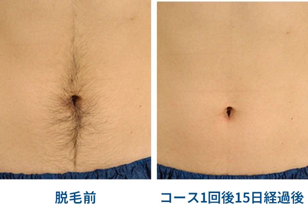 腹部脱毛効果