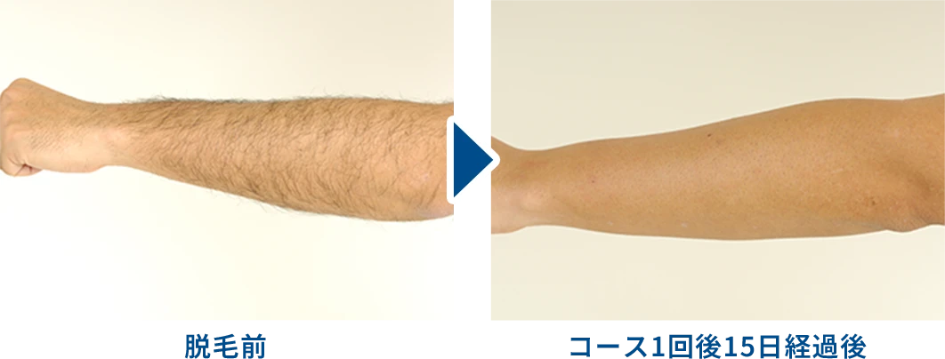 腕の脱毛効果