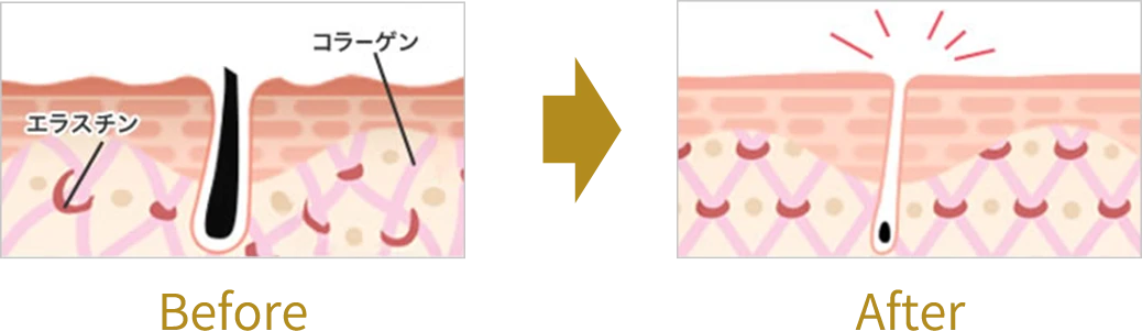 脱毛前後の肌の違い