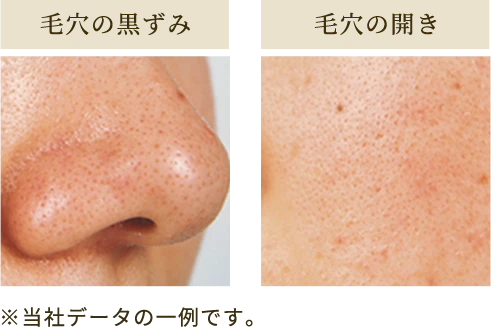 毛穴の黒ずみ・開き