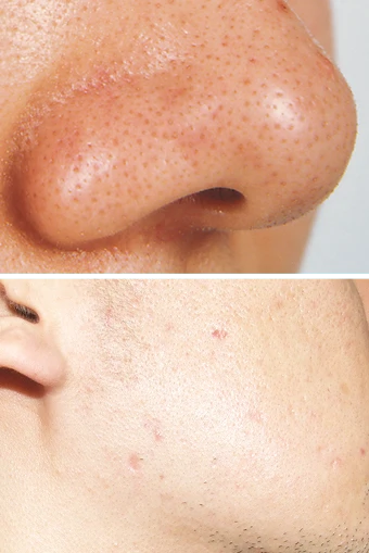 毛穴/ニキビケアコース