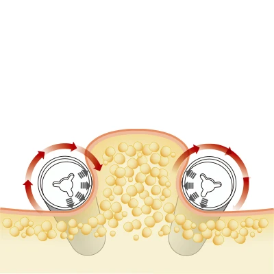 セルバーンM施術後