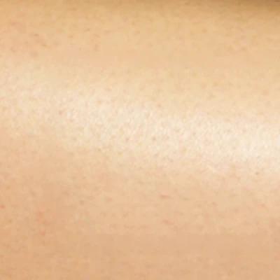 エピラッシュ後の肌