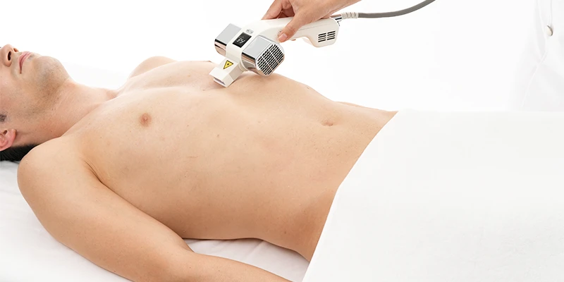 エピラッシュ（照射）