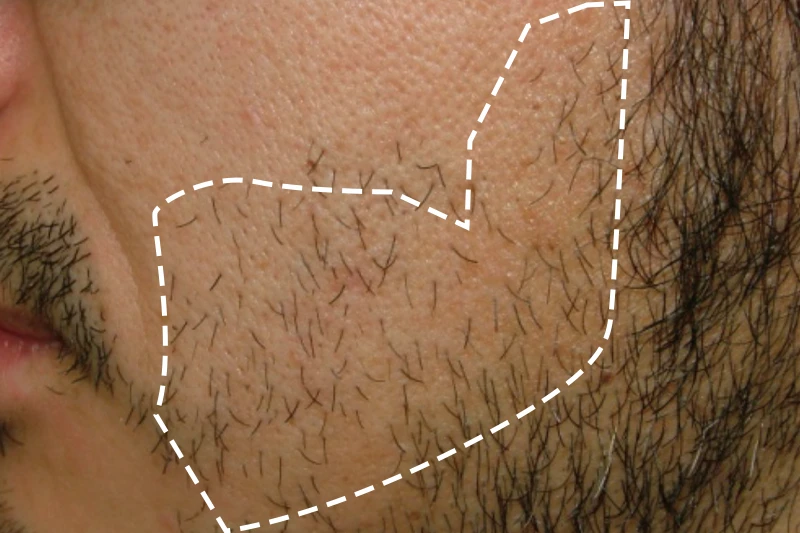 MEN'S TBCスーパー脱毛（美容電気脱毛）｜MEN'S TBC