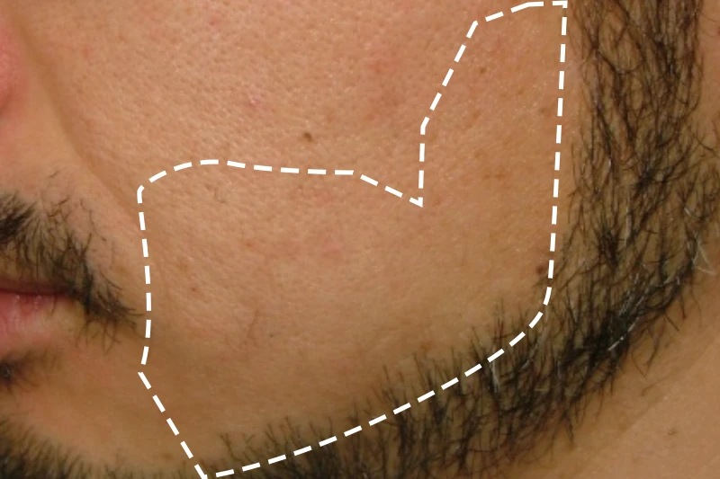 MEN'S TBCスーパー脱毛（美容電気脱毛）｜MEN'S TBC