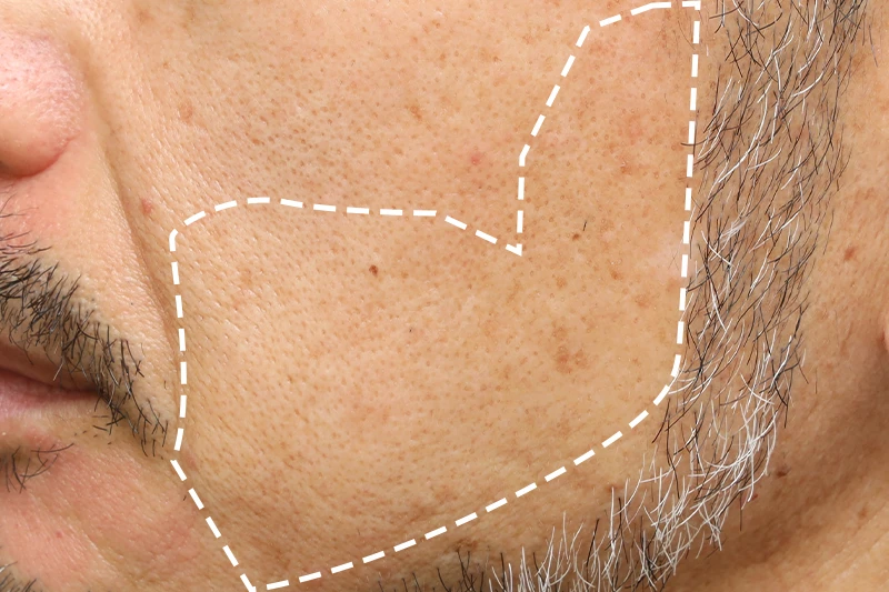 MEN'S TBCスーパー脱毛（美容電気脱毛）｜MEN'S TBC