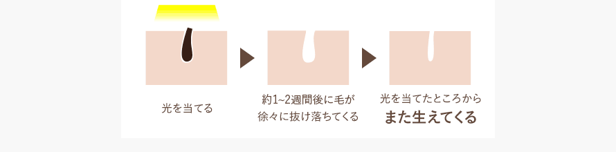 毛を作る組織にアプローチすることで抑毛・減毛していきます。毛は細くなりますがまた生えてきます