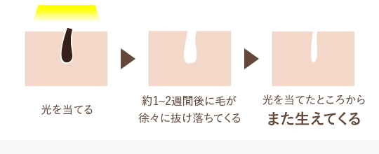 毛を作る組織にアプローチすることで抑毛・減毛していきます。毛は細くなりますがまた生えてきます