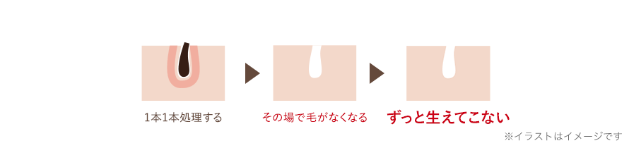 終わりのある脱毛