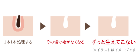 終わりのある脱毛