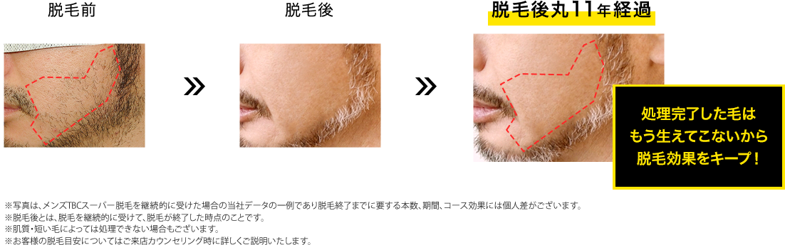 ヒゲ脱毛イメージ