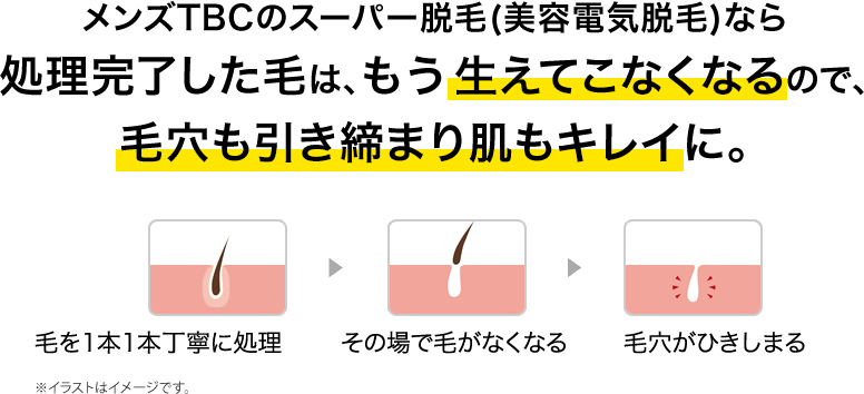メンズTBCのスーパー脱毛(美容電気脱毛)なら処理完了した毛は、もう生えてこなくなるので、毛穴も引き締まり肌もキレイに。