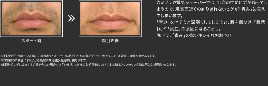 ヒゲ脱毛イメージ